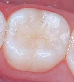 Zahn mit Füllungswerkstoff Komposit