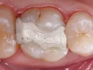 Zahn mit Zementfüllung