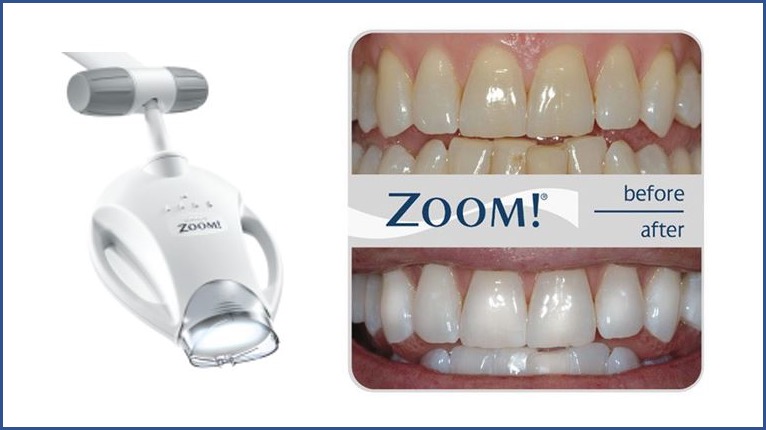 Gerät und Vergleich Zahnfarbe beim Philips-Zoom Bleaching-Verfahren