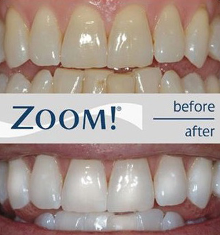 Vergleich Zahnaufhellung mit Zoom-Verfahren